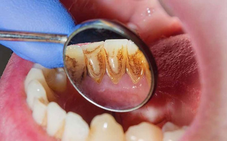 Điều trị viêm nướu và viêm nha chu
