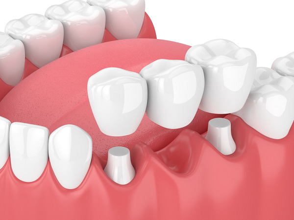 Phục hồi răng mất cố định