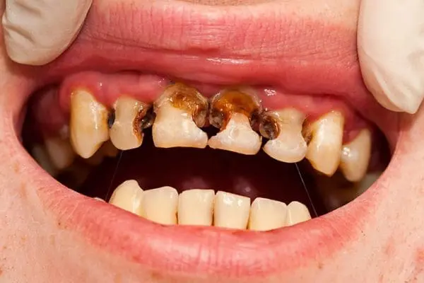 Sự Nguy Hiểm Của Việc Không Điều Trị Sâu Răng Kịp Thời